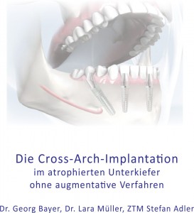 Die Cross-Arch-Implantation im athrophierten Unterkiefer ohne augmentative Verfahren